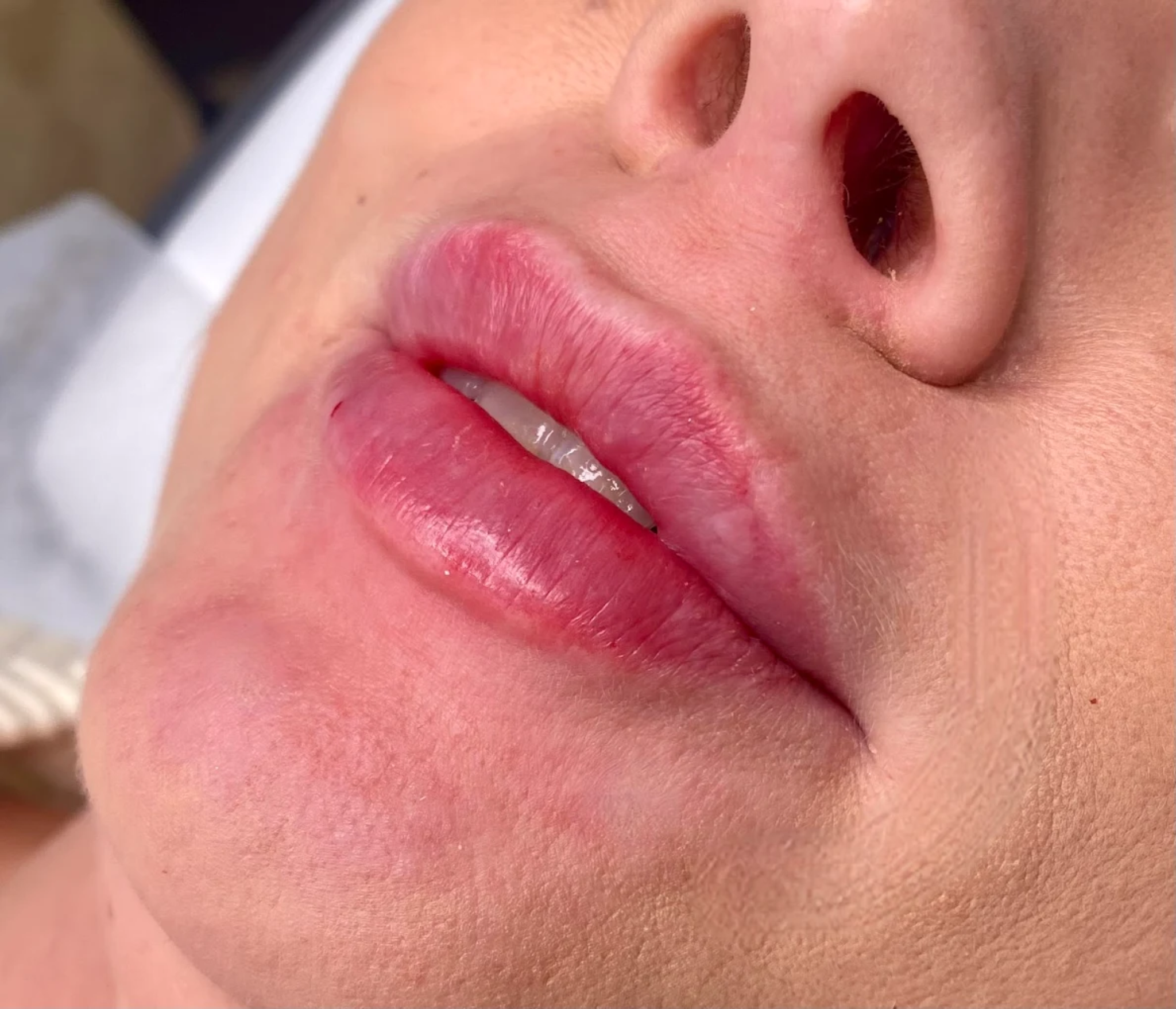 Modelowanie ust - efekt po zabiegu w ETERNA ESTETYKA Gliwice