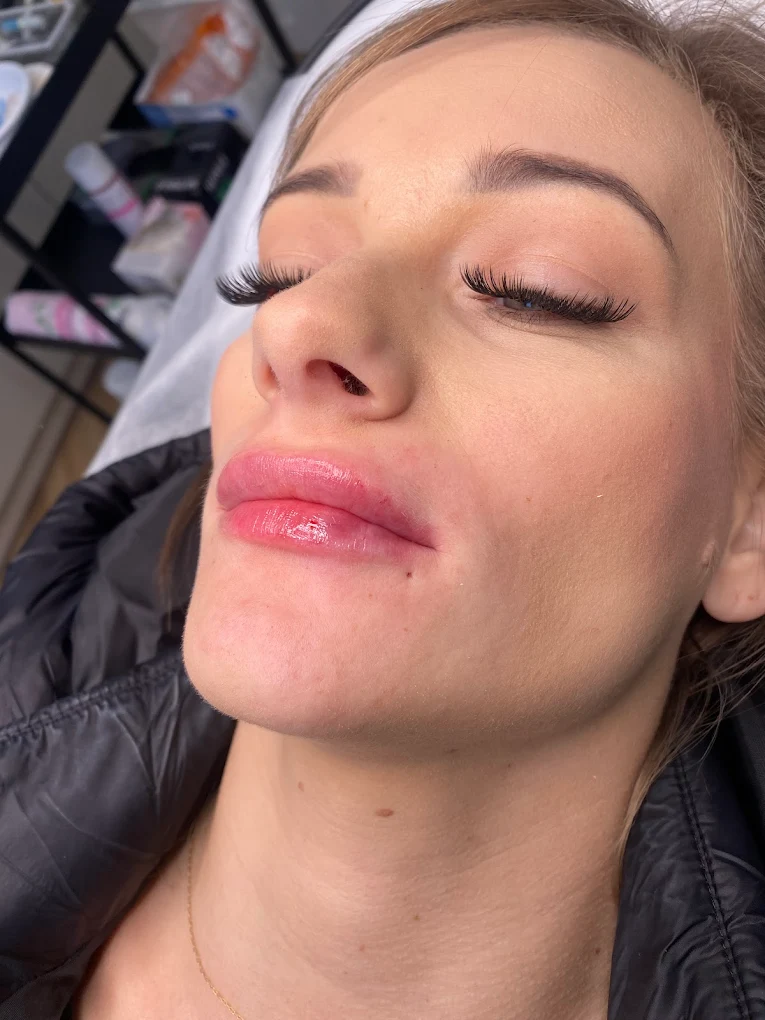 Usta po zabiegu - naturalny efekt w ETERNA ESTETYKA Gliwice