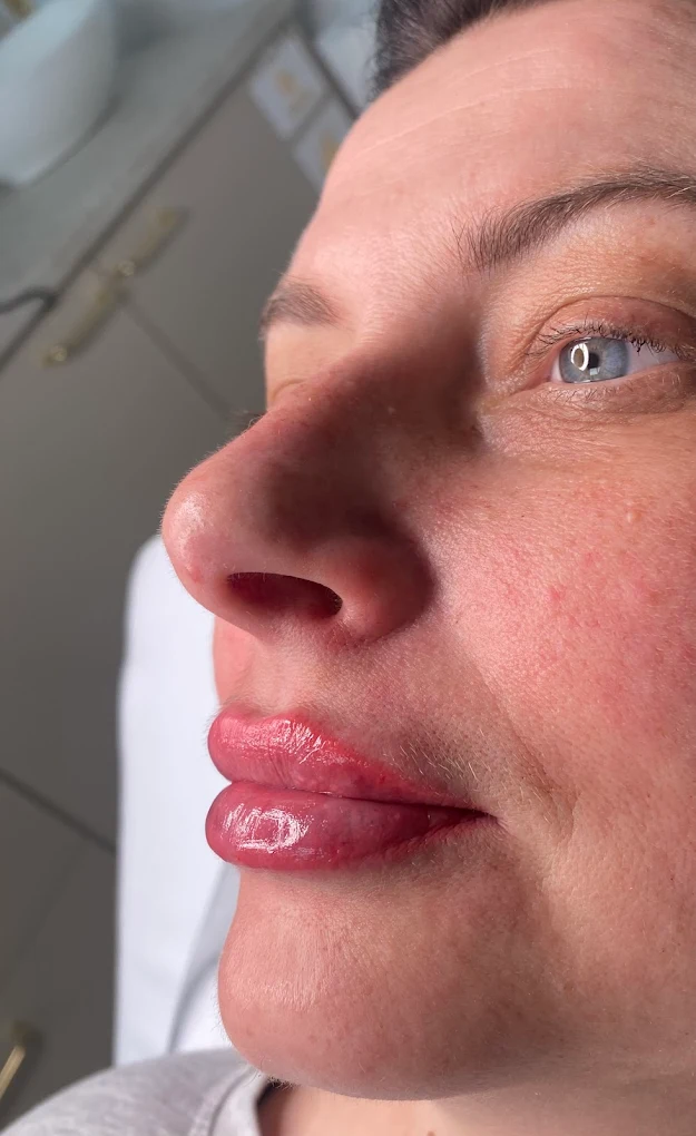 Profil po zabiegu modelowania ust - ETERNA ESTETYKA Gliwice