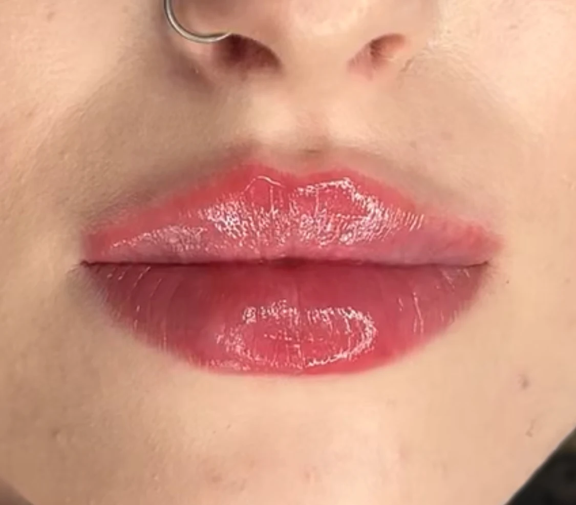 Efekt ust po zabiegu - ujęcie z przodu, ETERNA ESTETYKA Gliwice