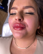 Efekt po zabiegu modelowania ust - zbliżenie, ETERNA ESTETYKA Gliwice